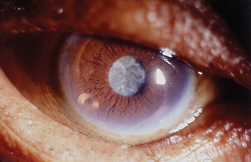 cataract