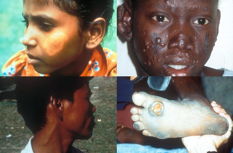 facts about leprosy