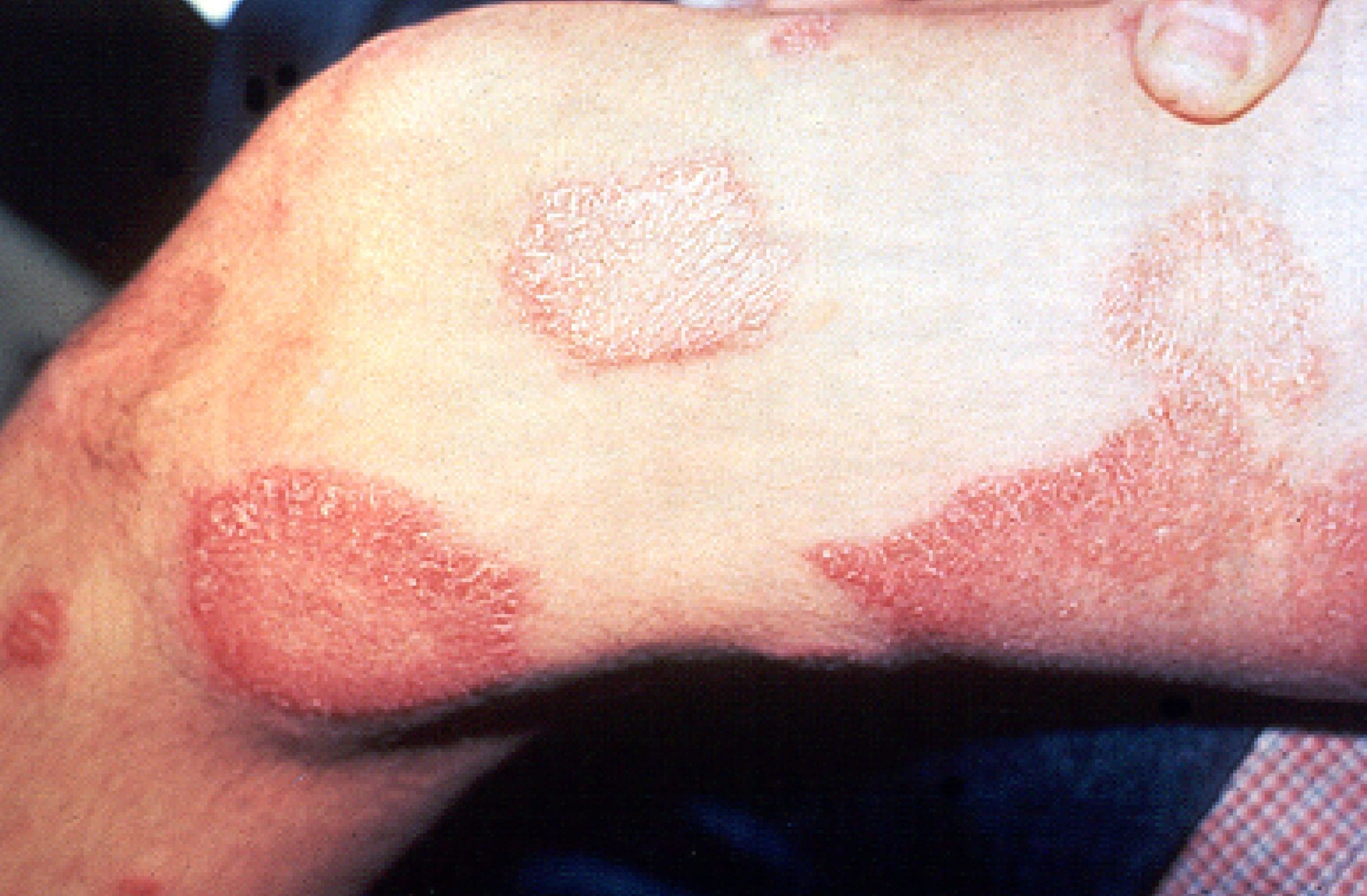 picture of leprosy disease