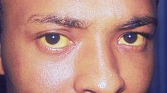 Hepatitis jaundice eyes