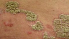 psoriasis