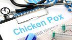 facts about chickenpox